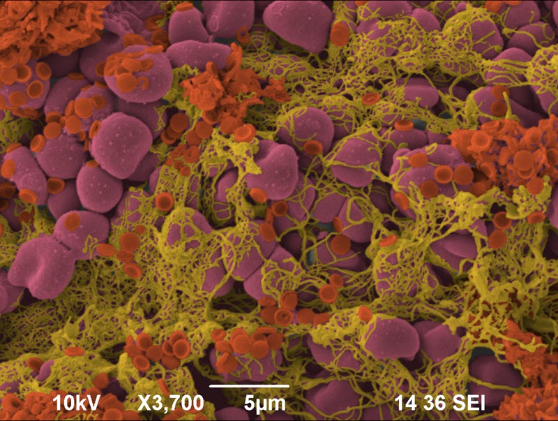 TITLE: Blood clot; SUBJECT: Red blood cells, Fibrin and DPNs (polymeric nanoparticles); CREDIT: Simone Lauciello, IIT - Fondazione Istituto Italiano di Tecnologia; METHOD/INSTRUMENT: JSM-6490LA
