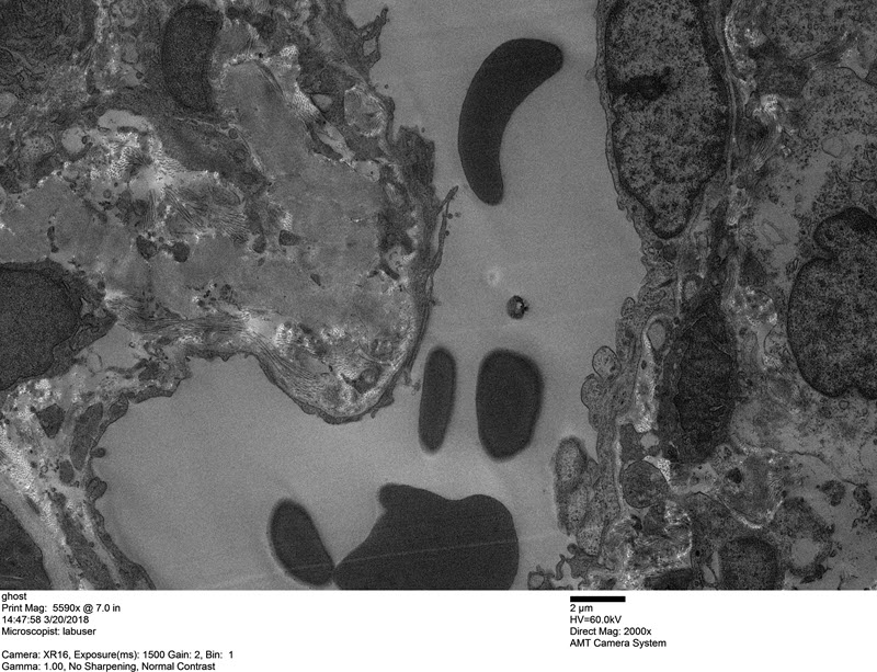 SUBJECT: Kidney biological sample; CREDIT: Linda Sims, Arkana Laboratories; METHOD/INSTRUMENT: JEOL JEM-1400Plus, 60kV, 2000x magnification, AMT bottom mount camera