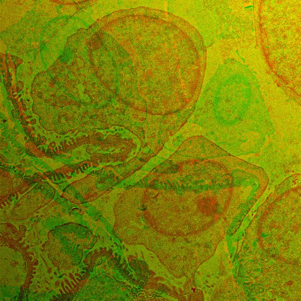 SUBJECT: Football processes of glomerular podocytes; CREDIT: Dr. Anil Kumar Pasupulati, Dept. Biochemistry, University of Hyderabad / Image taken at TEM center facility of IISER mohali By Ravinder Singh; METHOD/INSTRUMENT: TEM model JEM F200