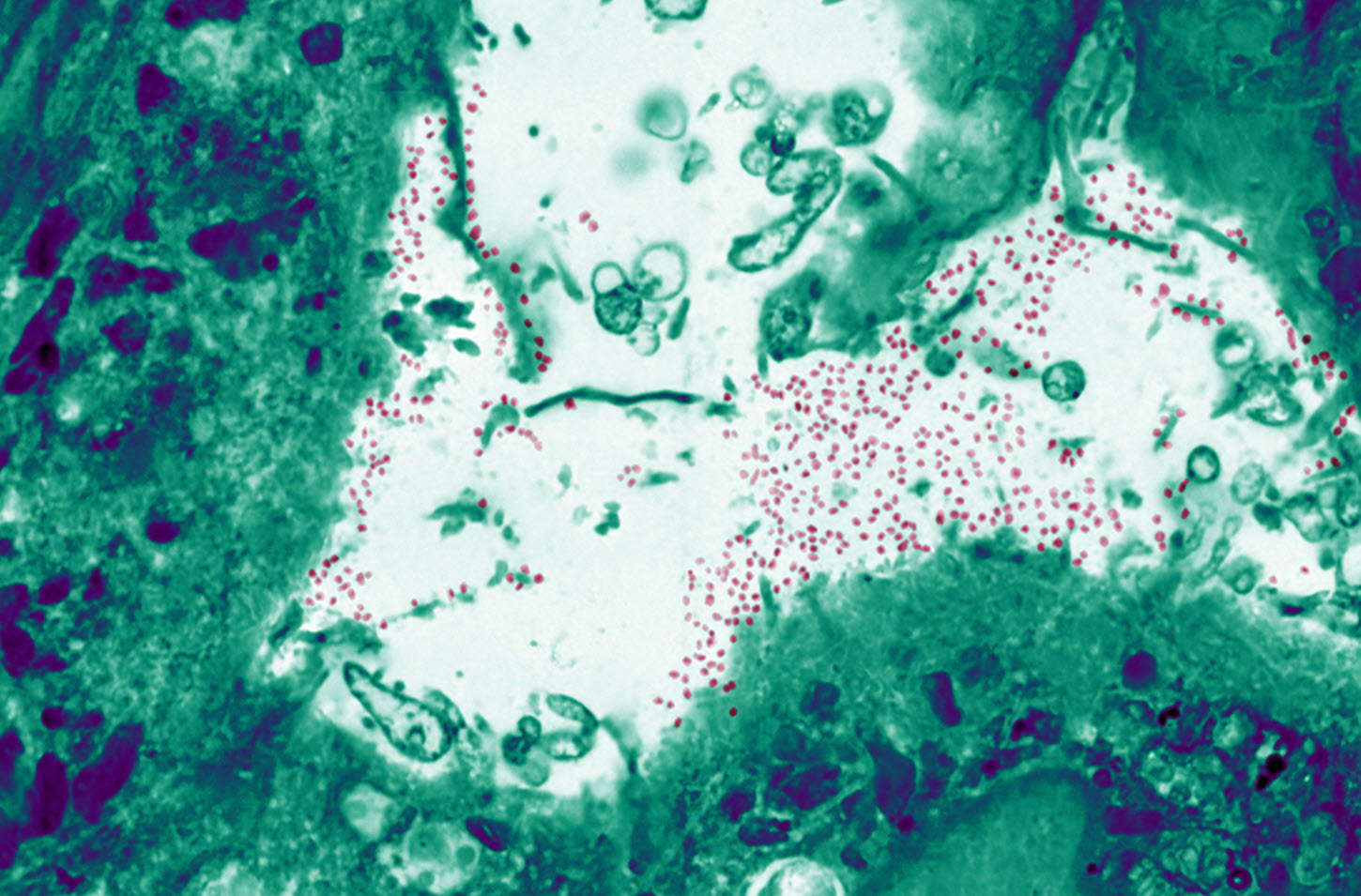 Covid19 infected cells imaged with JSM-6335F SEM